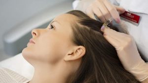 درمان ریزش مو با استفاده از مزوتراپی