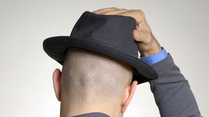استفاده از کلاه بعد از کاشت مو