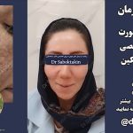 نمونه لیزر جای جوش، لیفت و روشن سازی