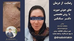 نمونه لیزر جای جوش، لیفت و روشن سازی