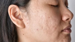 تکنیک‌های مدرن مدیریت اسکارهای پوستی و بازسازی پوست