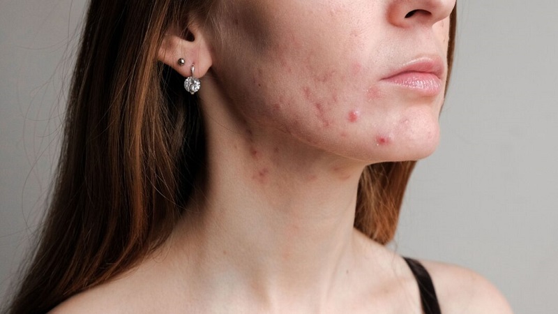 طیف وسیع آکنه‌های صورت در گذر عمر