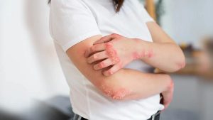 پیشگیری، تشخیص و درمان قارچ‌های پوستی شایع