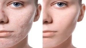 بهترین لیزر برای جای جوش کدام است؟