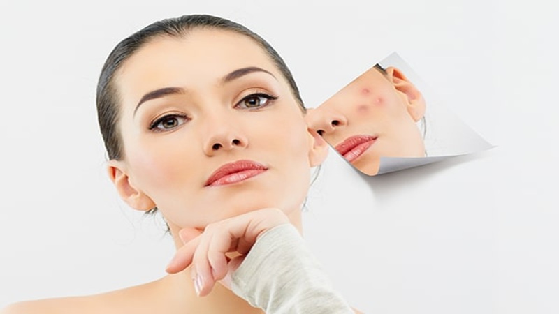لیزر جای جوش دائمی است یا موقتی؟
